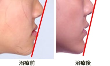 Eラインの整った矯正治療例