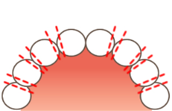 大人の矯正治療で歯を削る方法