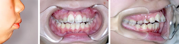 出っ歯の治療例：大人治療前