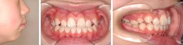 出っ歯の治療例：大人治療後