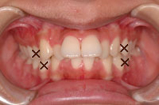 出っ歯の治療例：大人治療前