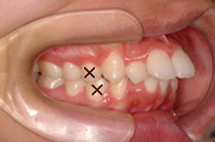 出っ歯の治療例：大人治療前