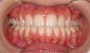 出っ歯の治療例：大人治療後