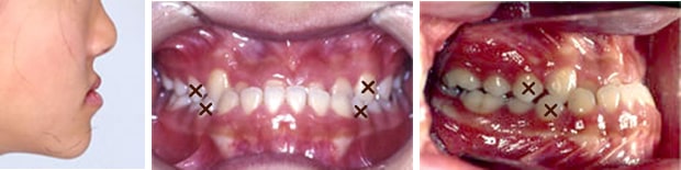 受け口の治療例：10代治療前