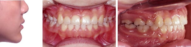 受け口の治療例：10代治療後