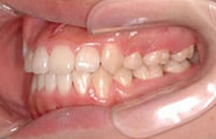 開咬の治療例：大人治療後