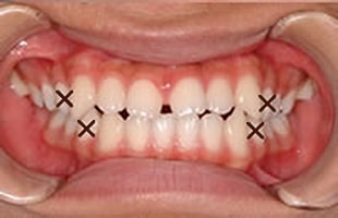 空隙歯列の治療例：大人治療前