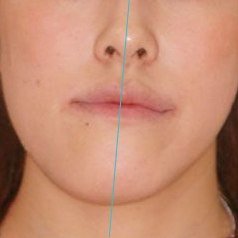 外科手術を伴う治療（外科的矯正治療）