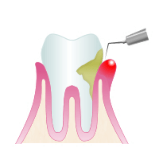 歯周病検査