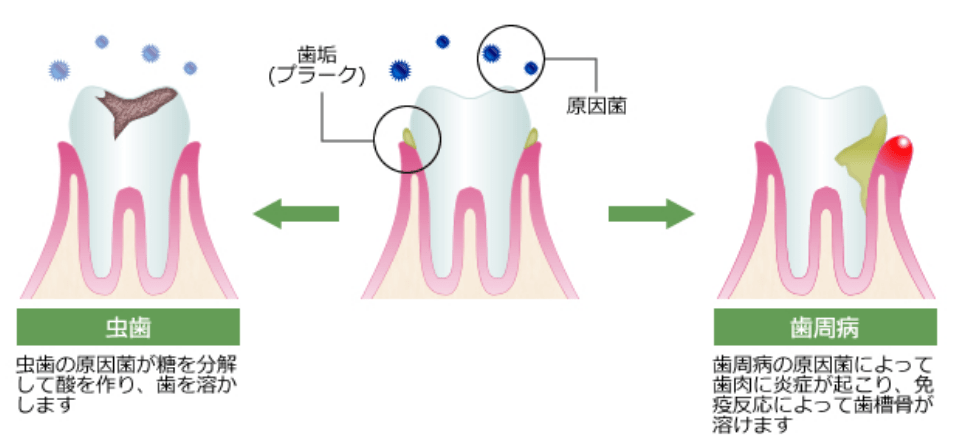 むし歯、歯周病の説明