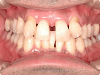 矯正治療前の歯並び