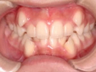 歯並びの矯正治療前のお悩み