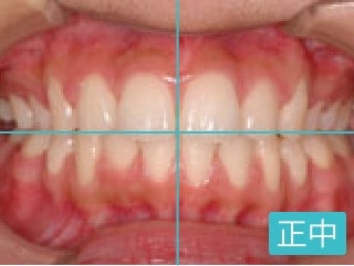 治療後のきれいな歯並び