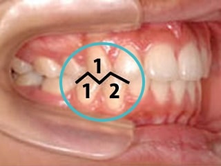 噛み合わせ　矯正治療前のお悩み
