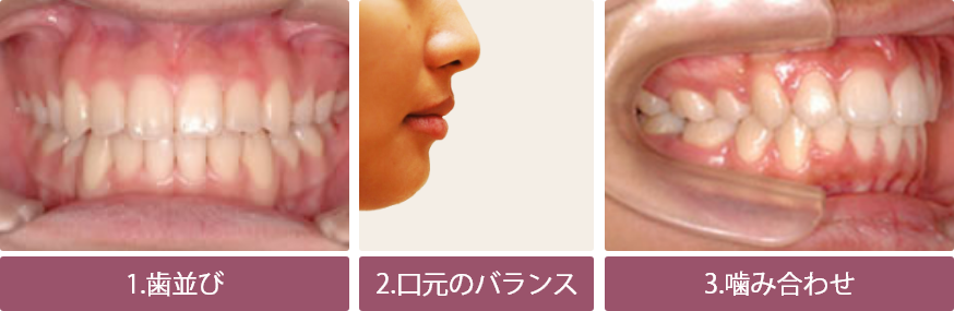 歯科矯正治療3つのポイント