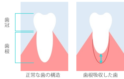 歯根吸収について