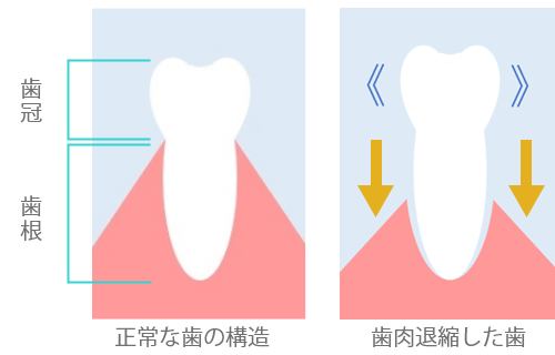 歯肉退縮について